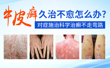 头部牛皮癣的治疗方法是什么