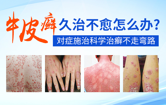 什么时期治疗牛皮癣效果最好